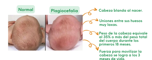 27-03-2023 plagiocefalia